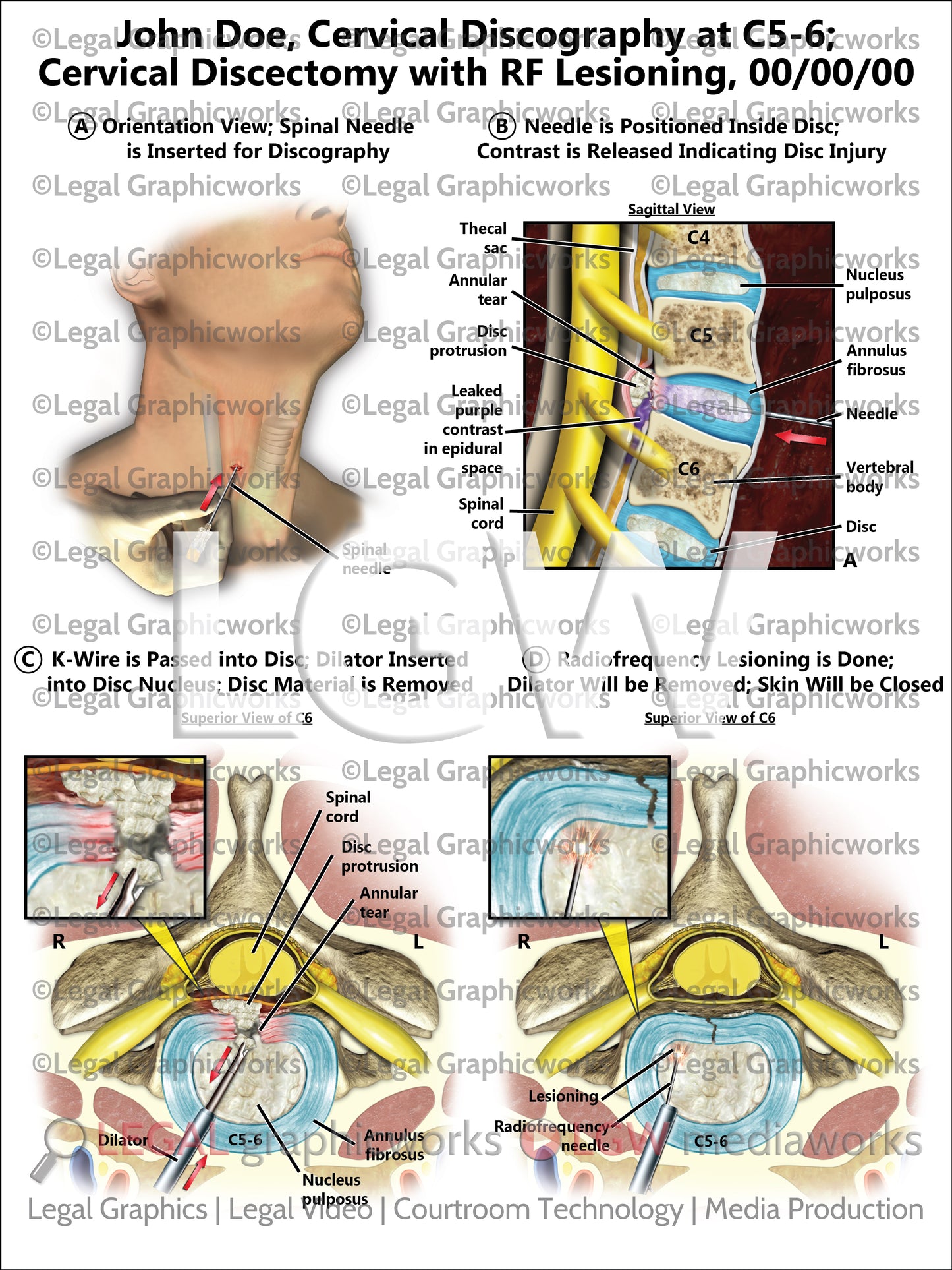 Cervical Discography at C5-6; Cervical Discectomy with RF Lesioning