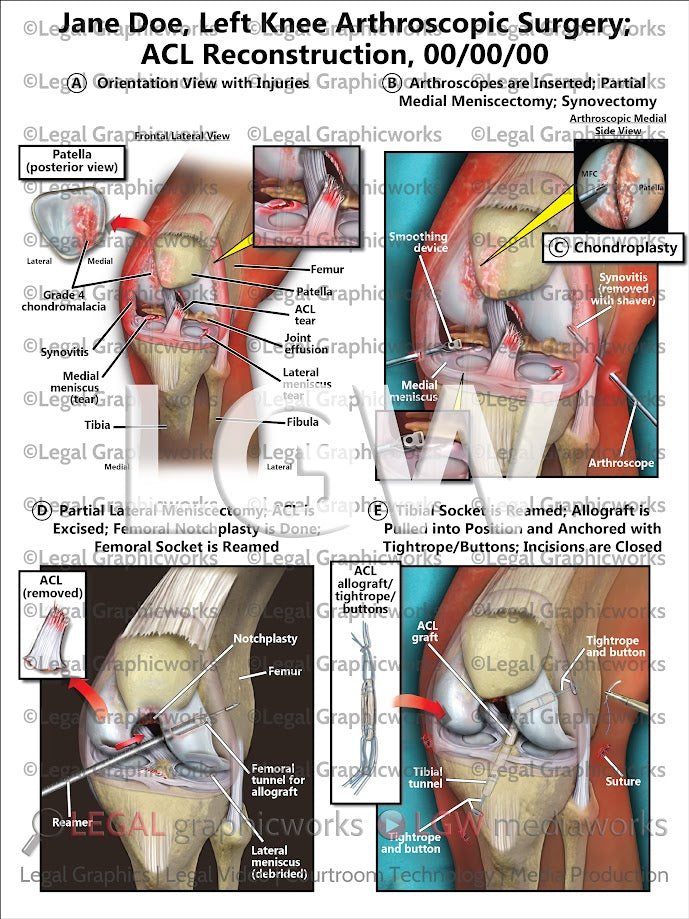 Left Knee Arthroscopic Surgery; ACL Reconstruction