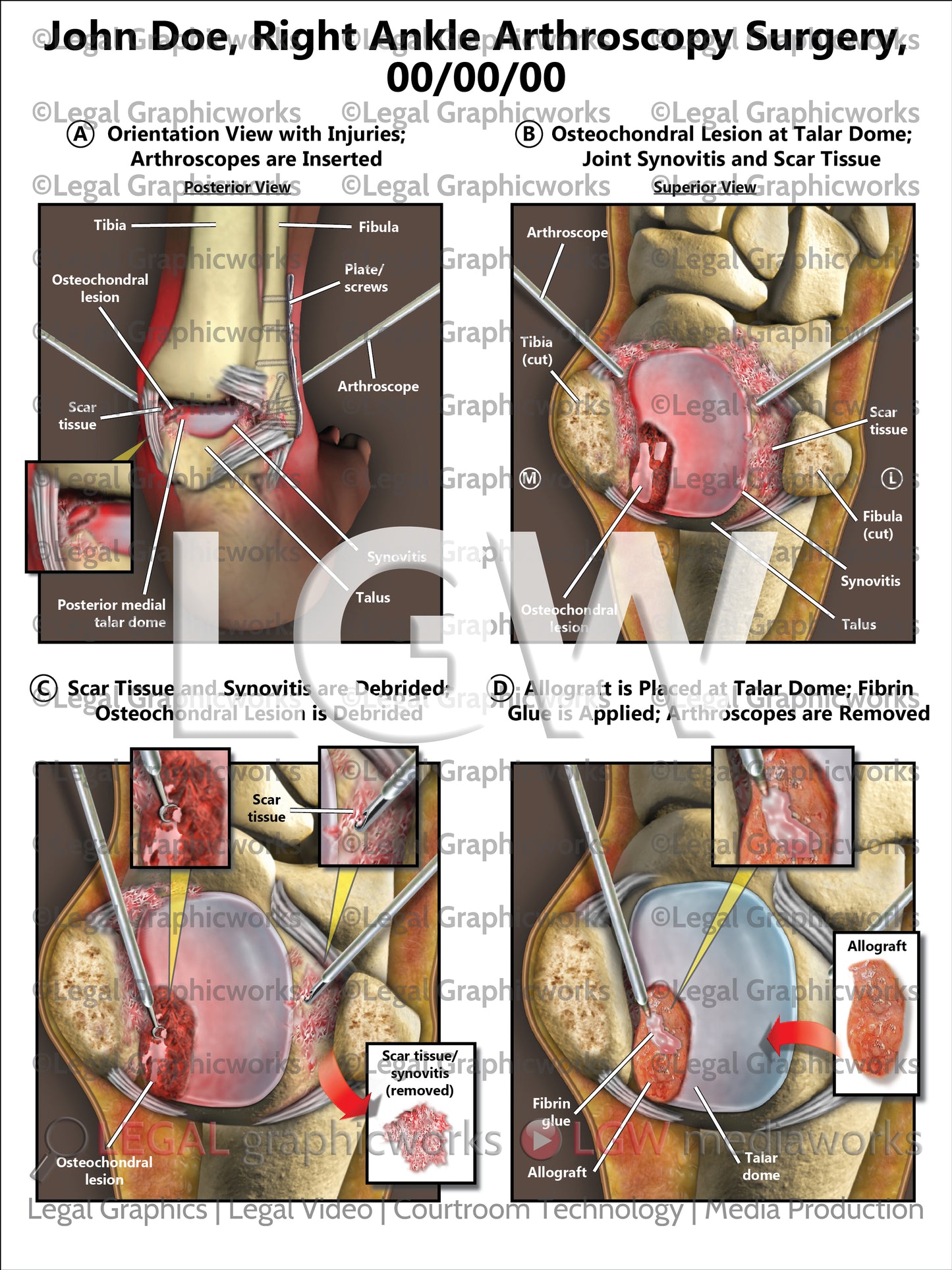 Right Ankle Arthroscopy Surgery