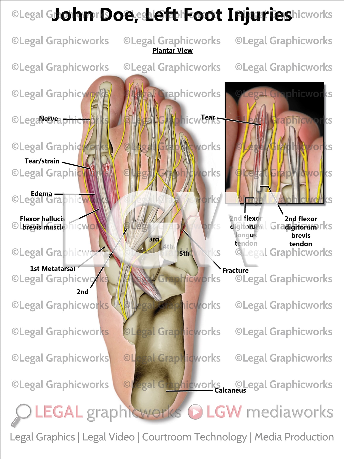 Left Foot Injuries