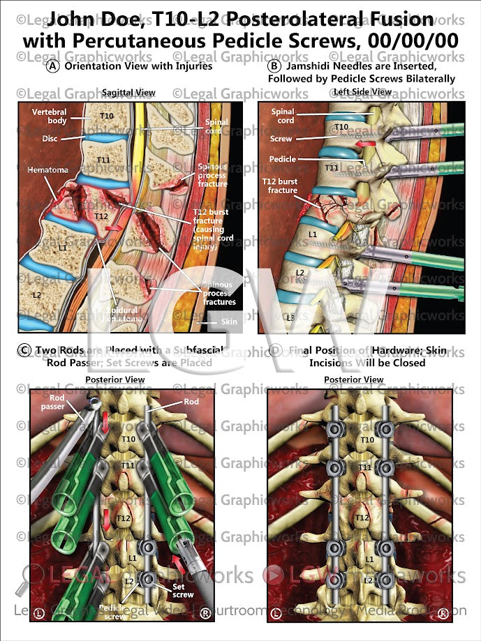 T10-L2 Posterolateral Fusion with Percutaneous Pedicle Screws