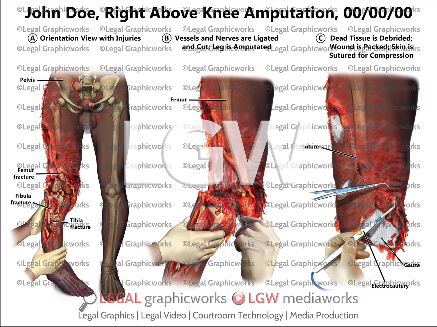 Right Above Knee Amputation
