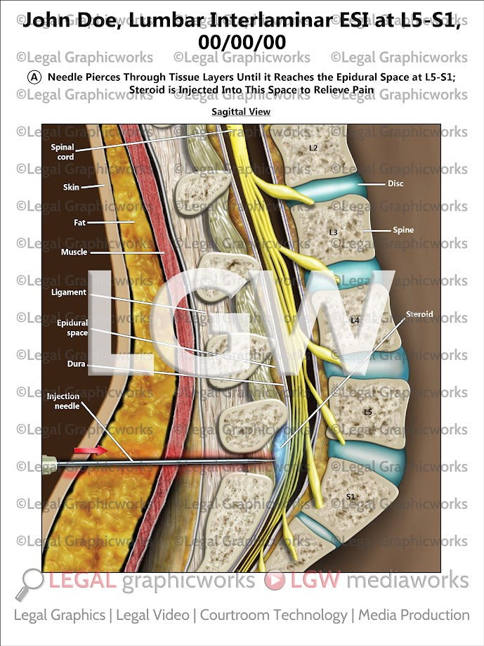 Lumbar Interlaminar ESI at L5-S1