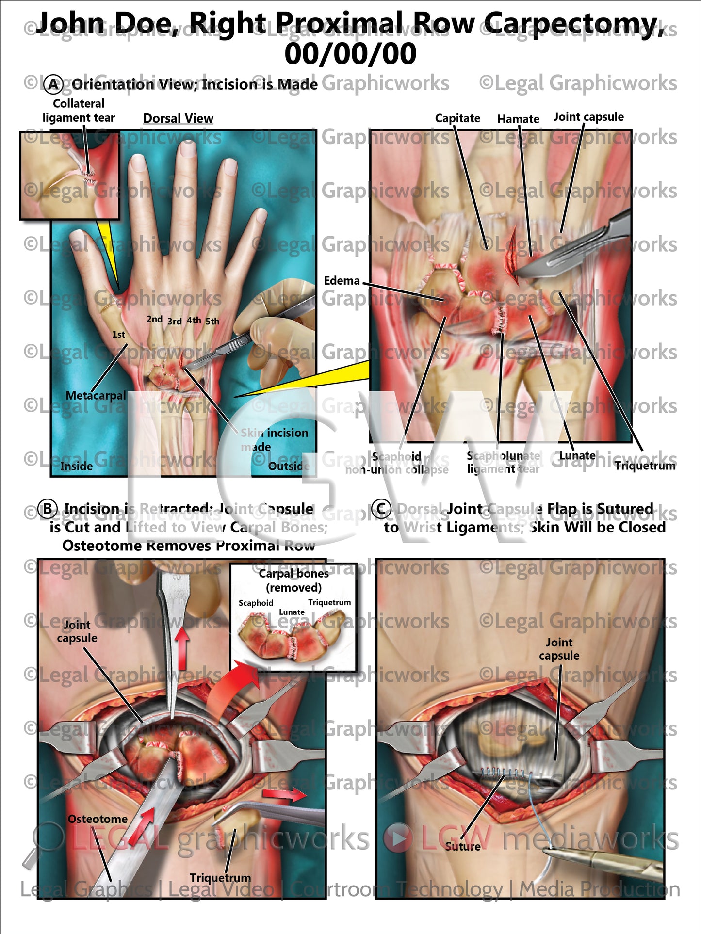Right Proximal Row Carpectomy