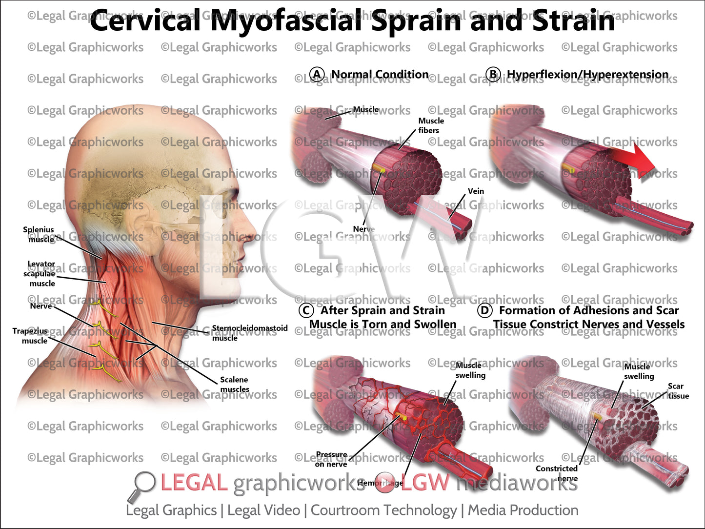 Cervical Myofascial Sprain and Strain