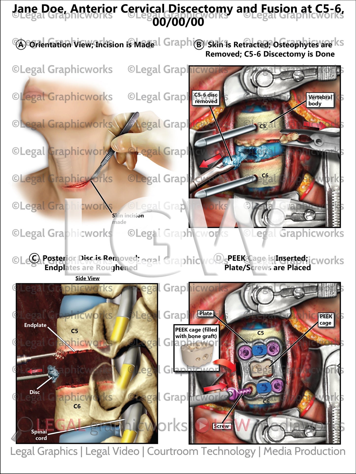 Anterior Cervical Discectomy and Fusion at C5-6