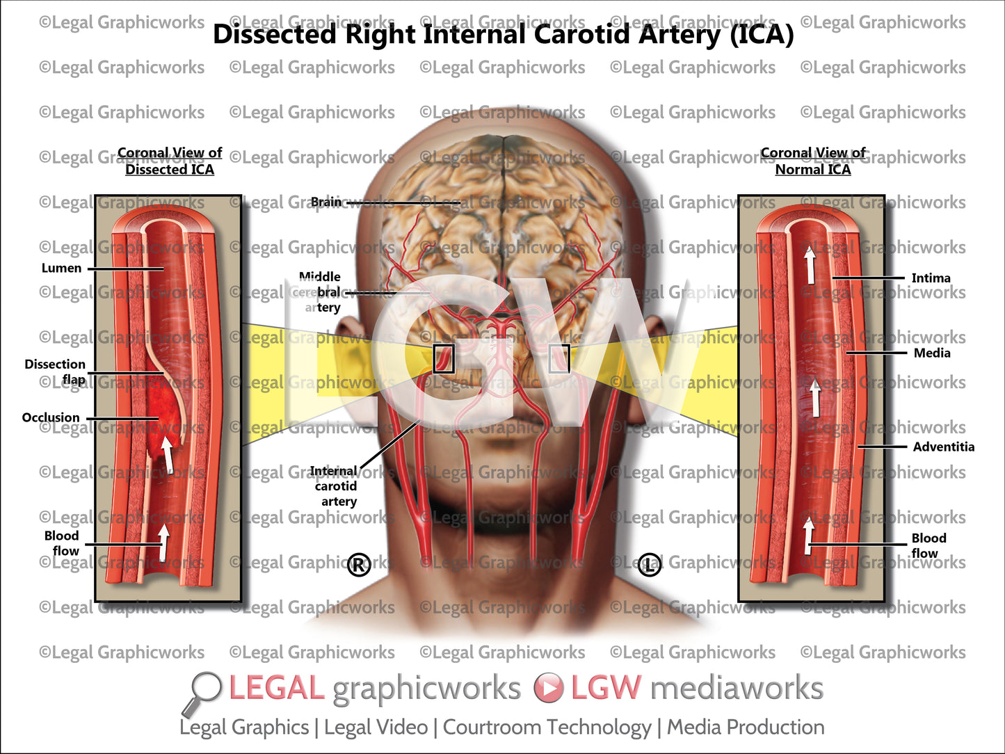 Dissected Right Internal Carotid Artery (ICA)