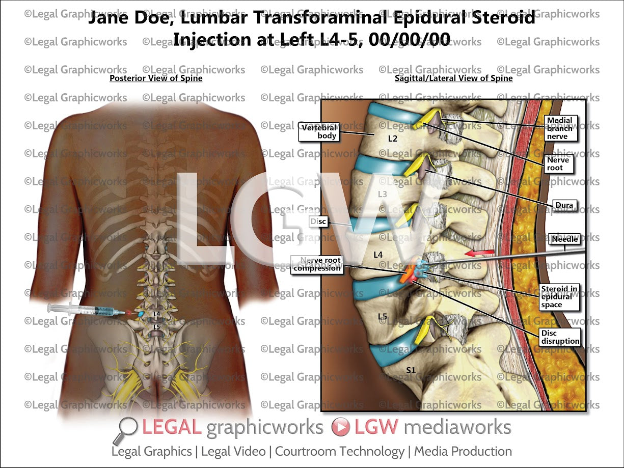 Lumbar Transforaminal Epidural Steroid Injection at Left L4-5