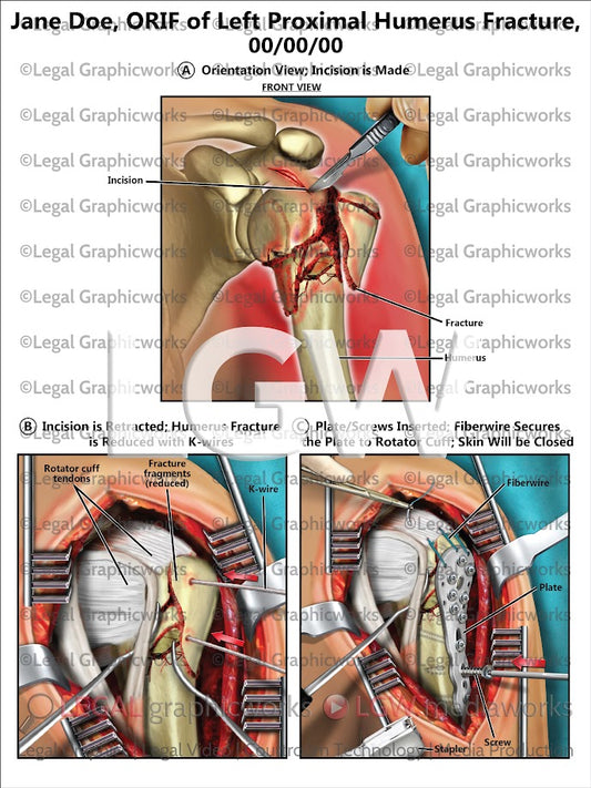 ORIF of Left Proximal Humerus Fracture