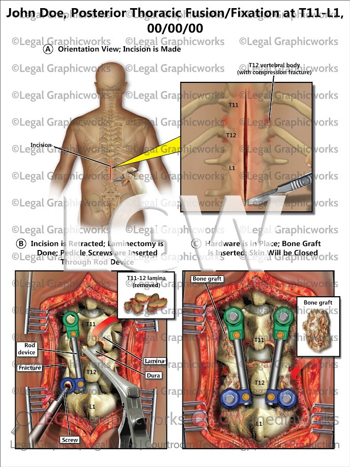 Posterior Thoracic Fusion/Fixation at T11-L1