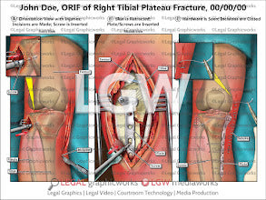 ORIF of Right Tibial Plateau Fracture