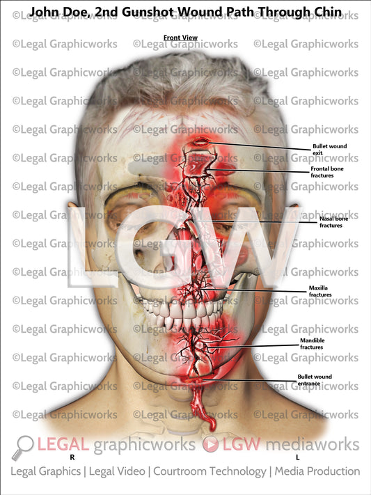 2nd Gunshot Wound Path Through Chin