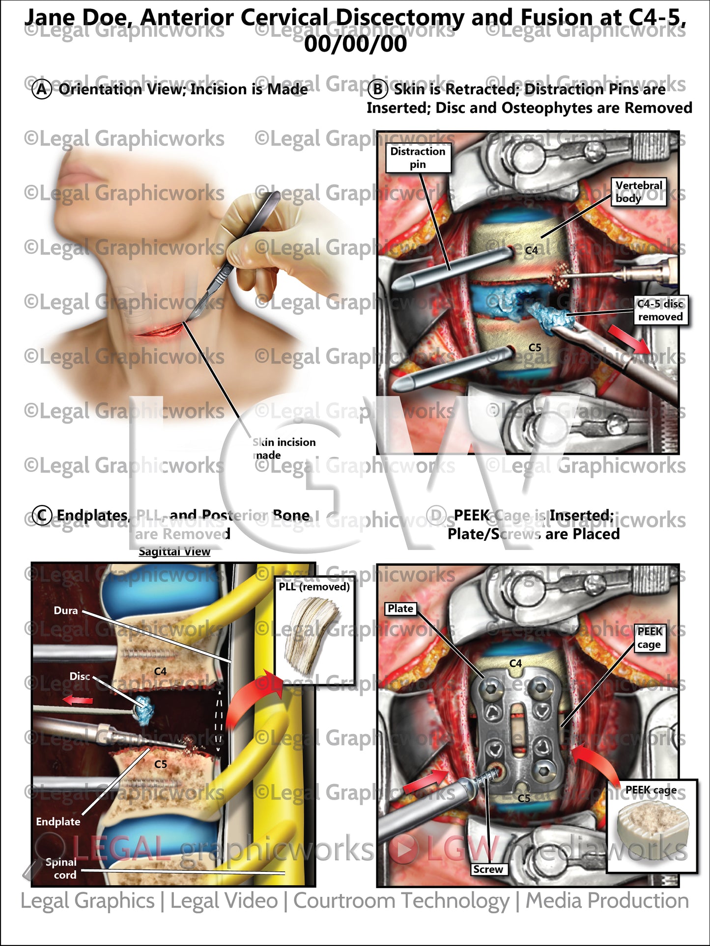 Anterior Cervical Discectomy and Fusion at C4-5