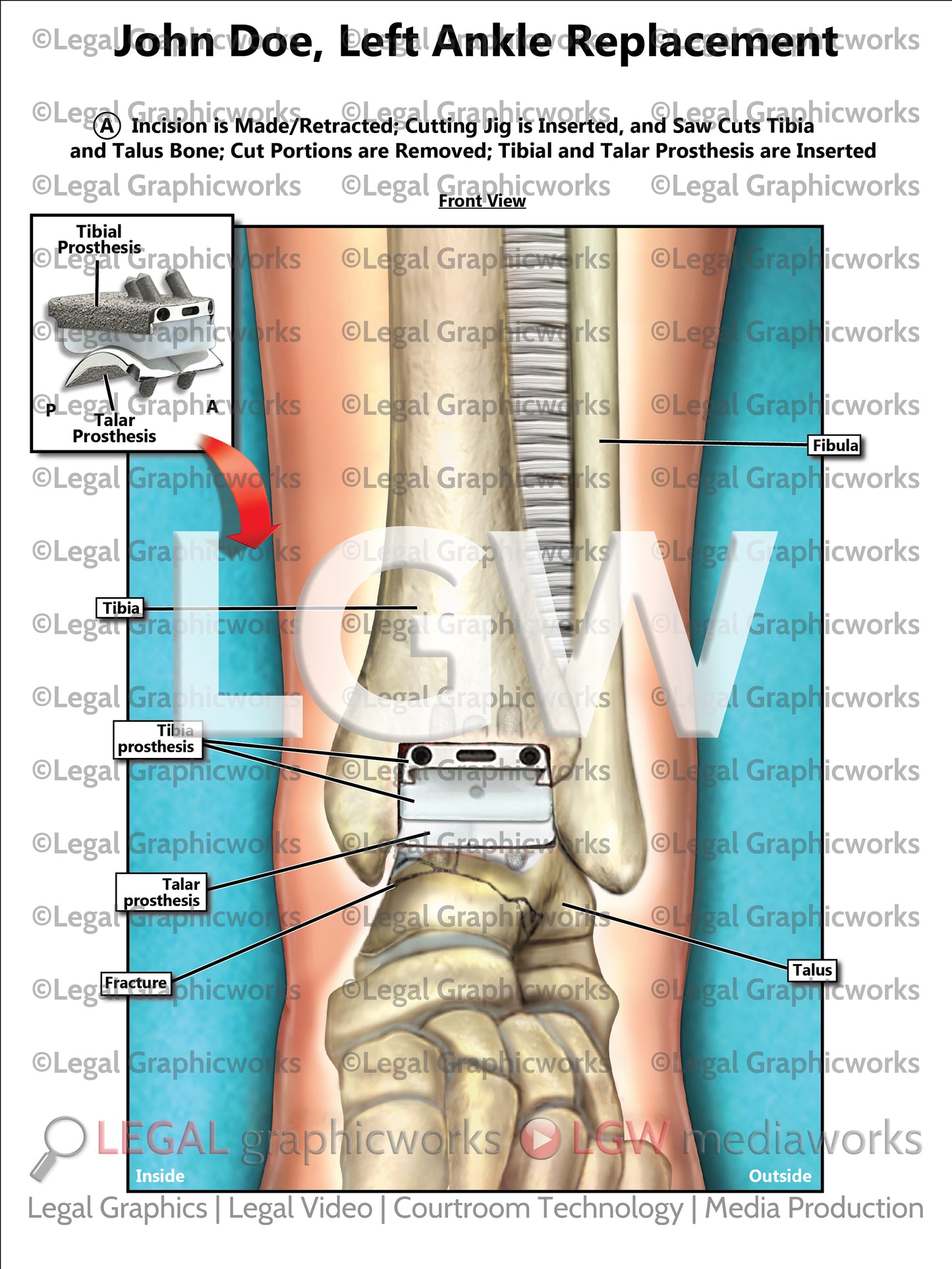 Left Ankle Replacement