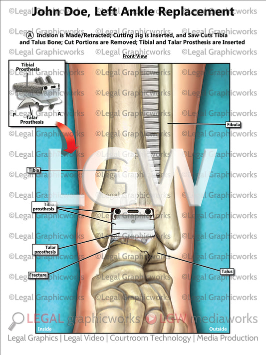 Left Ankle Replacement