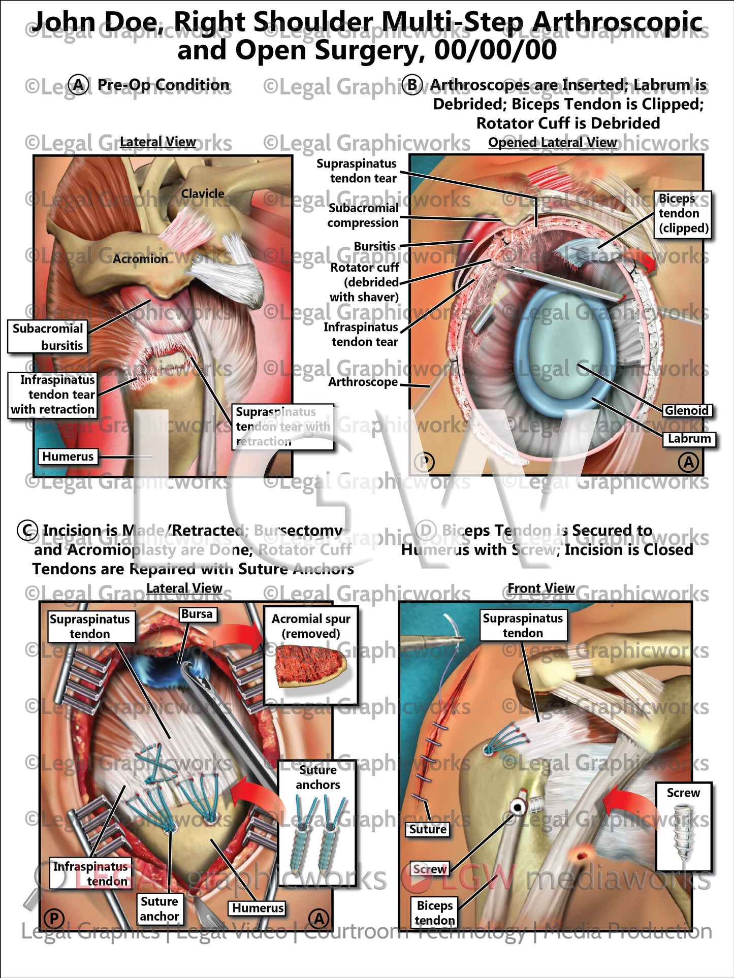 Right Shoulder Multi-Step Arthroscopic and Open Surgery