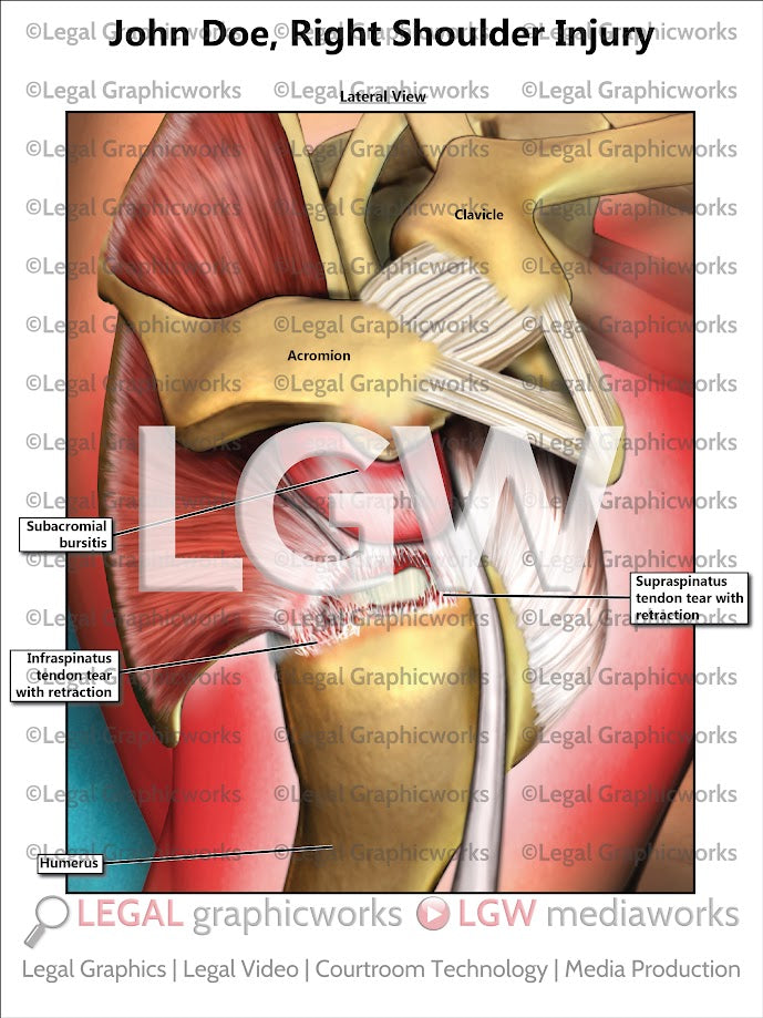 Right Shoulder Injury