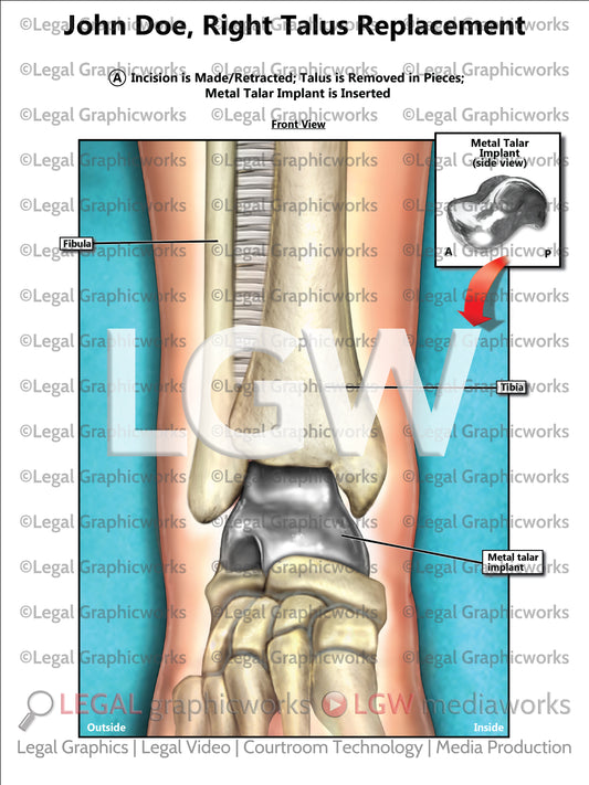Right Talus Replacement
