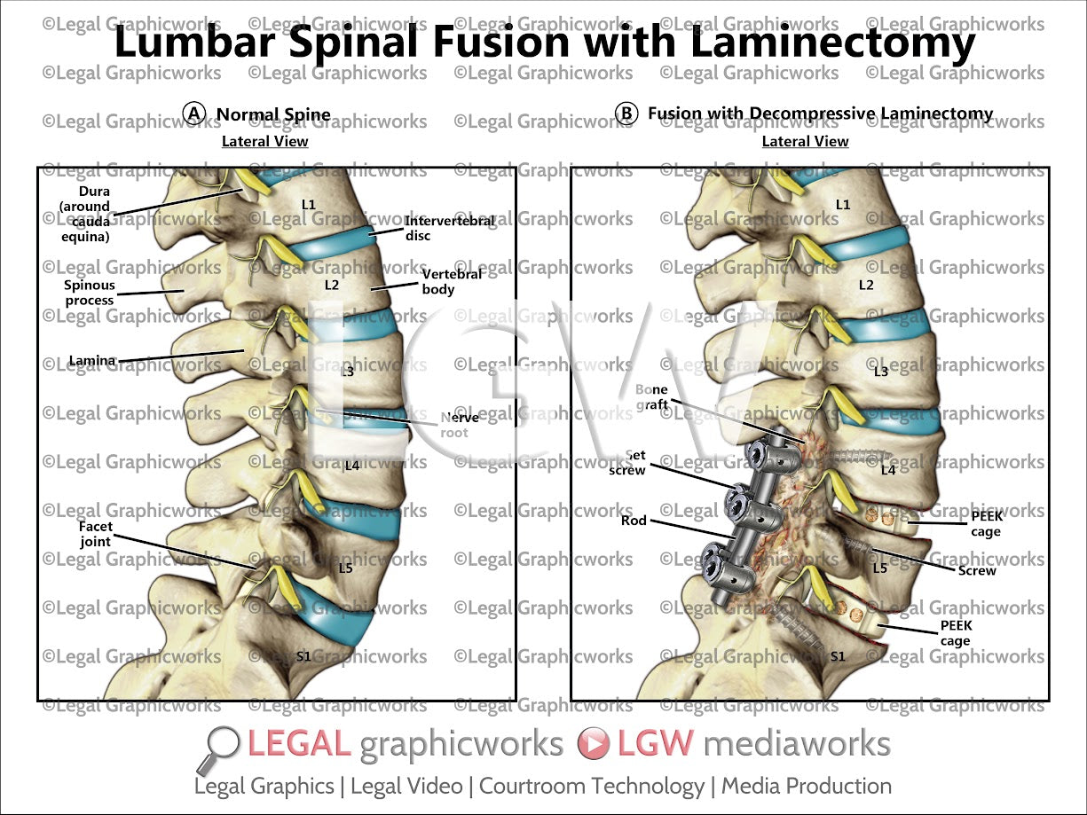 Lumbar Spinal Fusion with Laminectomy