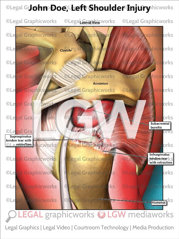 Left Shoulder Injury