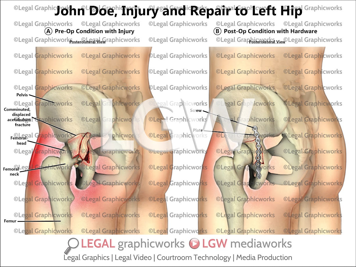 Injury and Repair to Left Hip