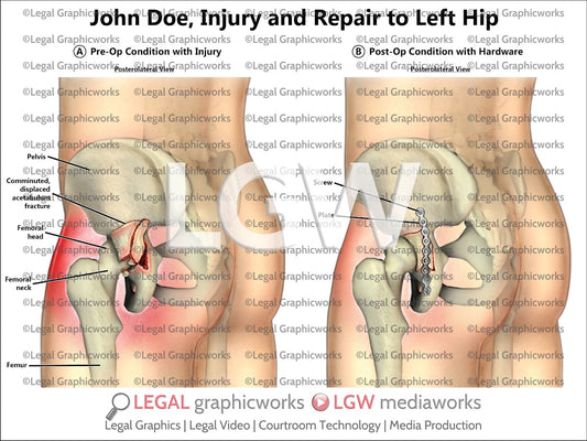Injury and Repair to Left Hip