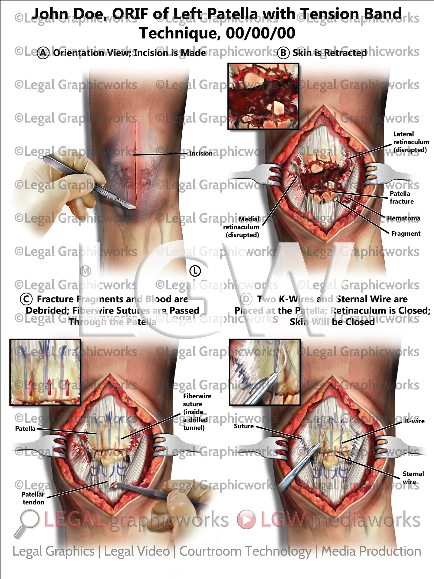 ORIF of Left Patella with Tension Band Technique