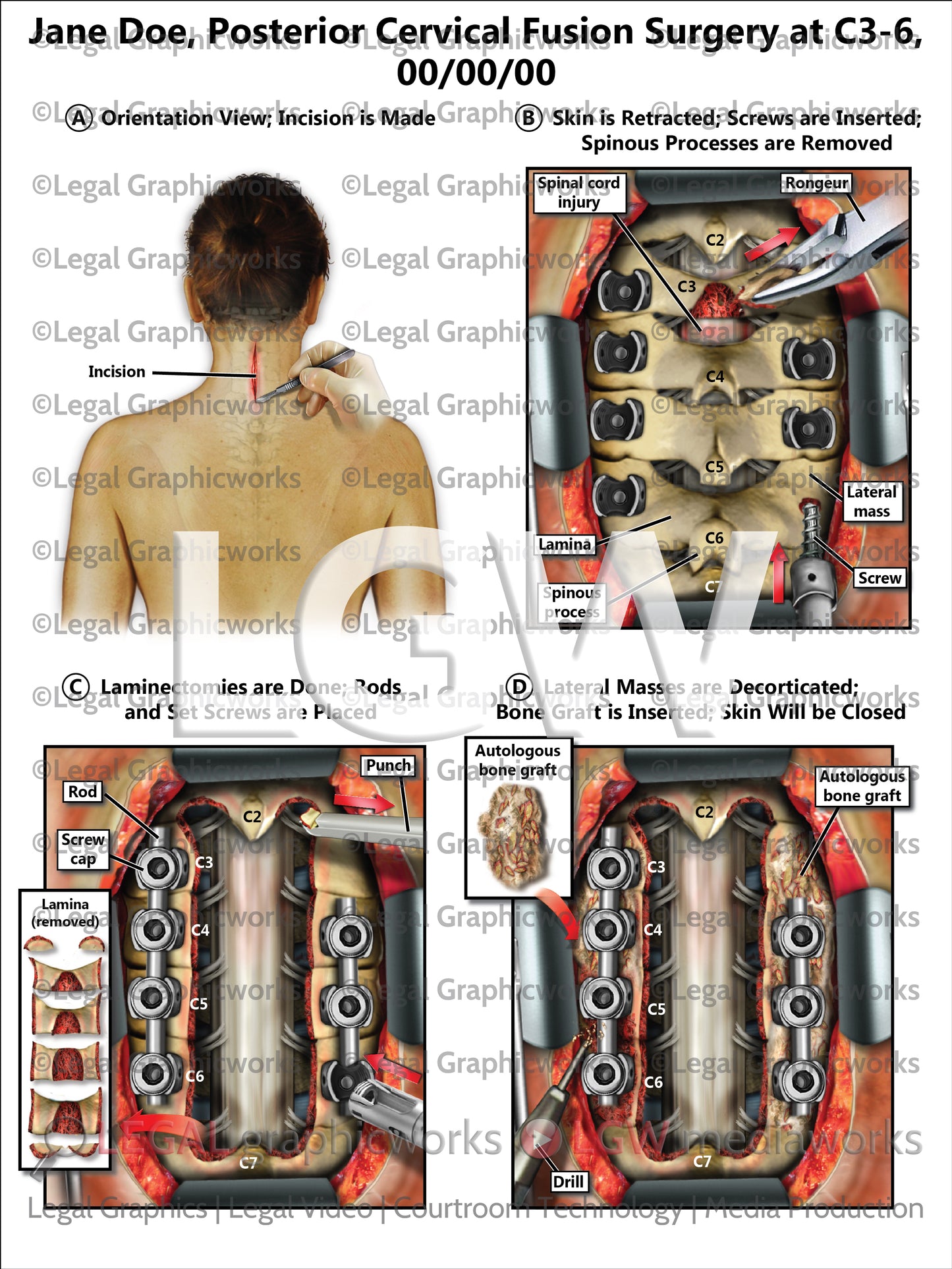 Posterior Cervical Fusion Surgery at C3-6