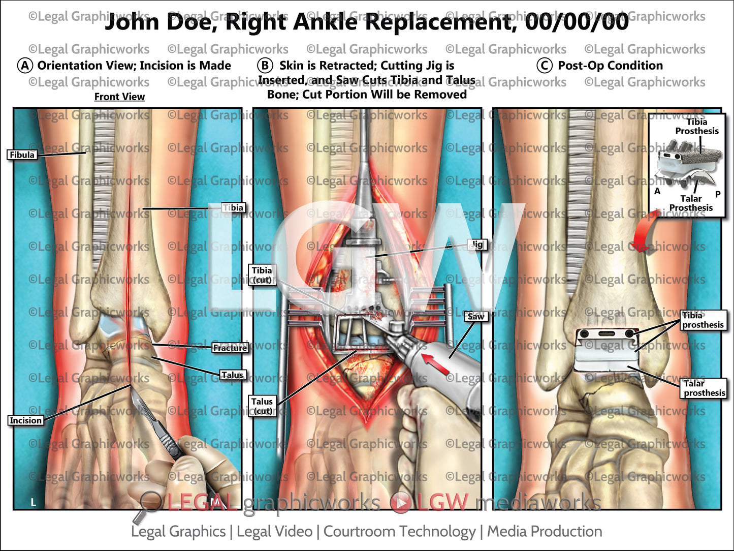 Right Ankle Replacement