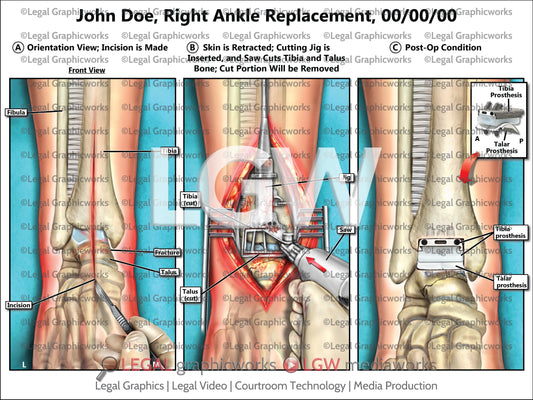 Right Ankle Replacement