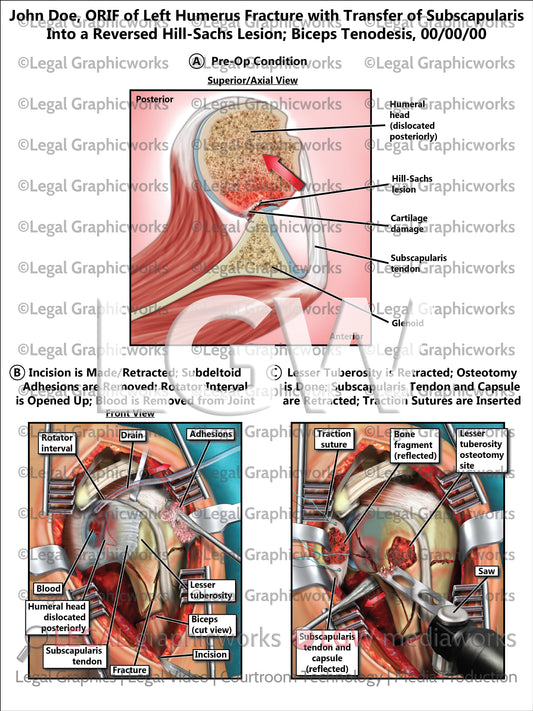 ORIF of Left Humerus Fracture with Transfer of Subscapularis Into a Reversed Hill-Sachs Lesion; Biceps Tenodesis