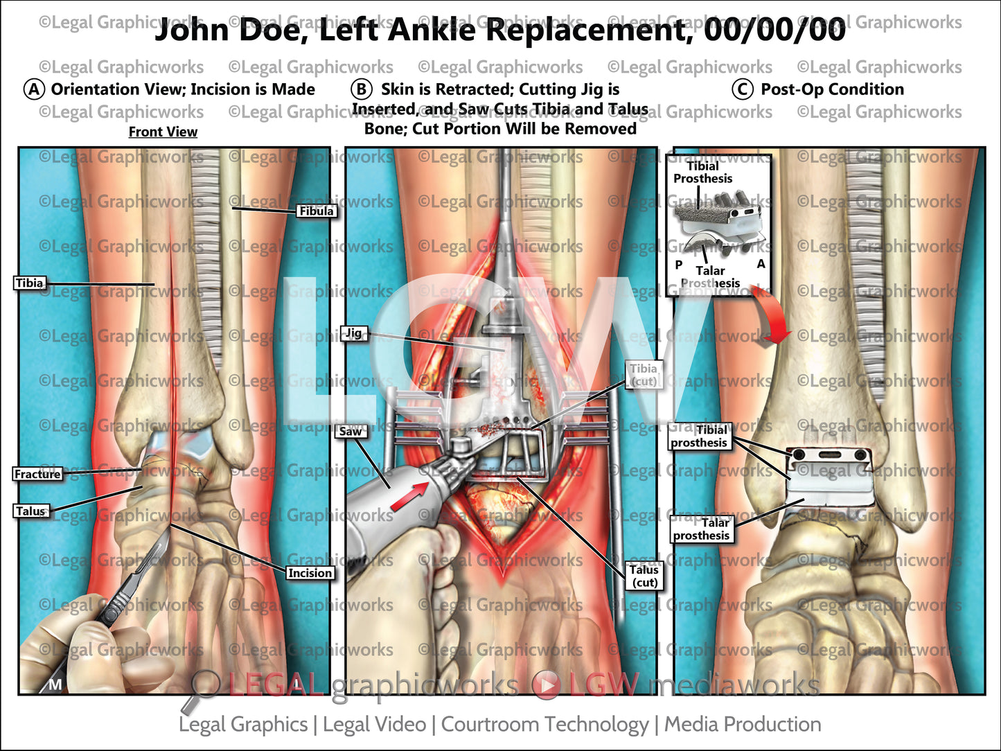 Left Ankle Replacement