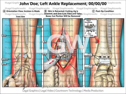 Left Ankle Replacement