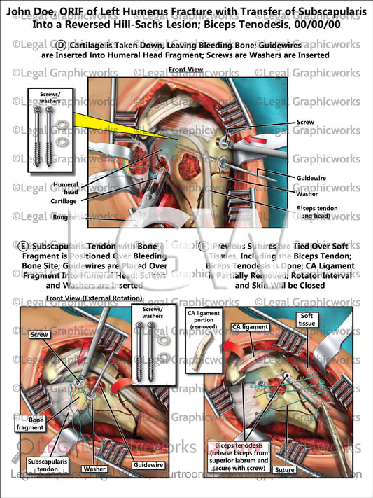 ORIF of Left Humerus Fracture with Transfer of Subscapularis Into a Reversed Hill-Sachs Lesion; Biceps Tenodesis