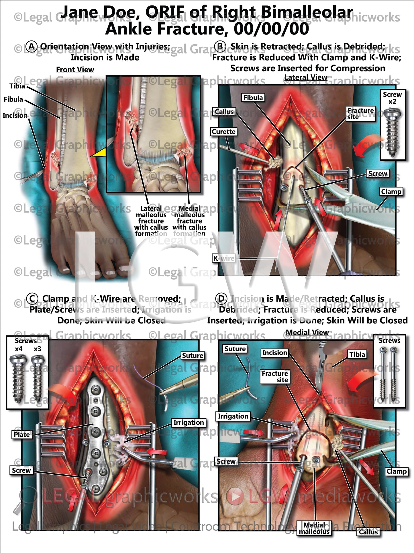 ORIF of Right Bimalleolar Ankle Fracture