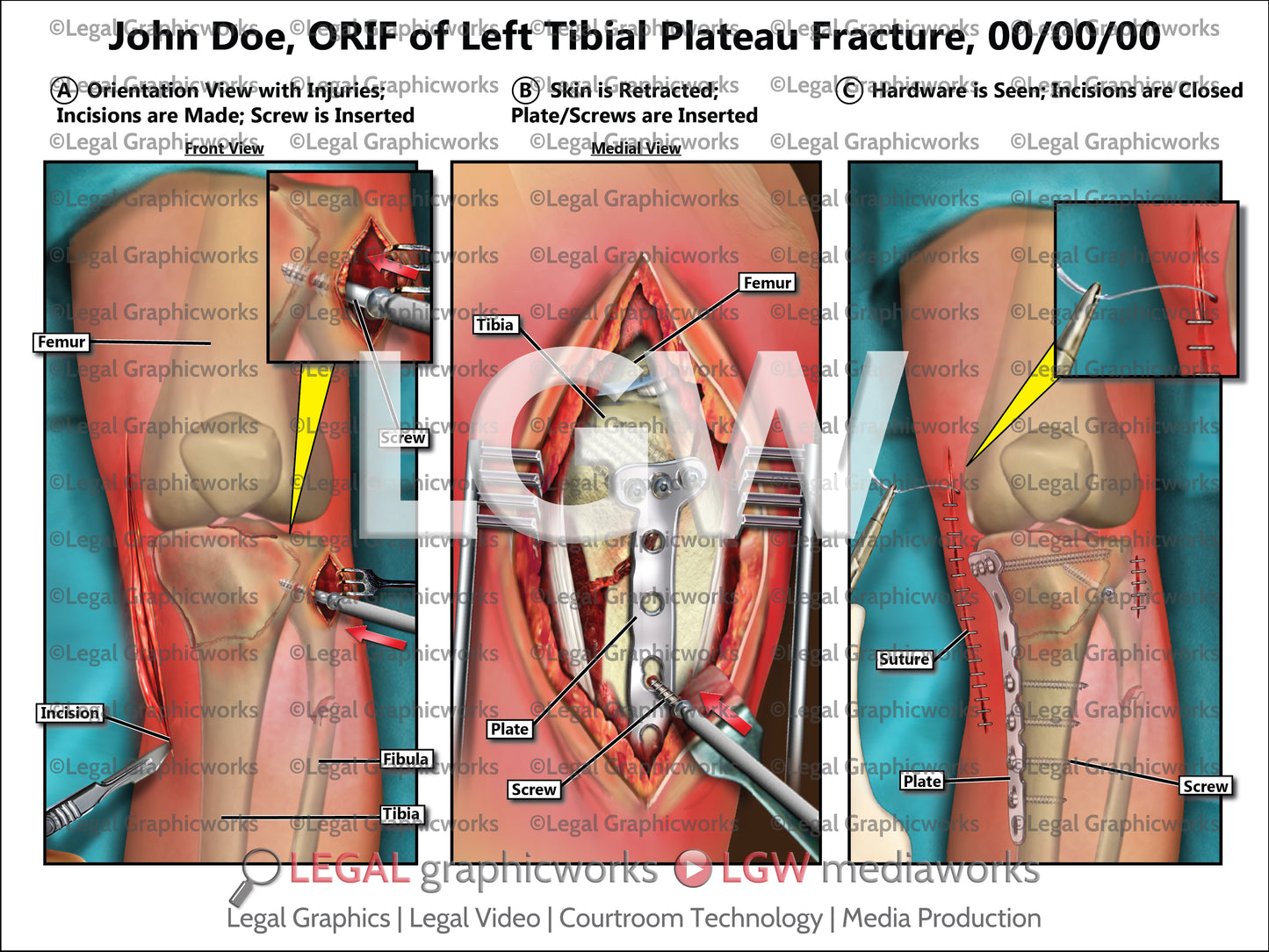 ORIF of Left Tibial Plateau Fracture