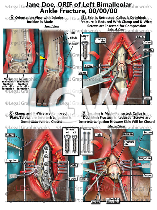 ORIF of Left Bimalleolar Ankle Fracture