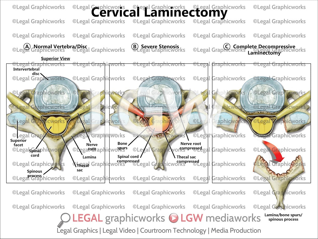 Cervical Laminectomy