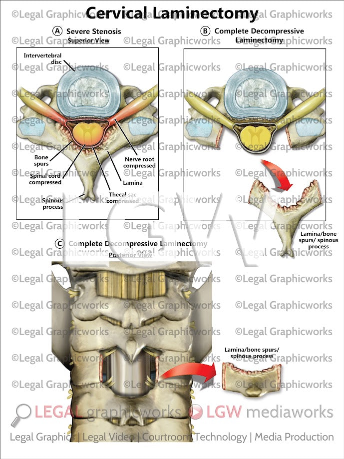Cervical Laminectomy