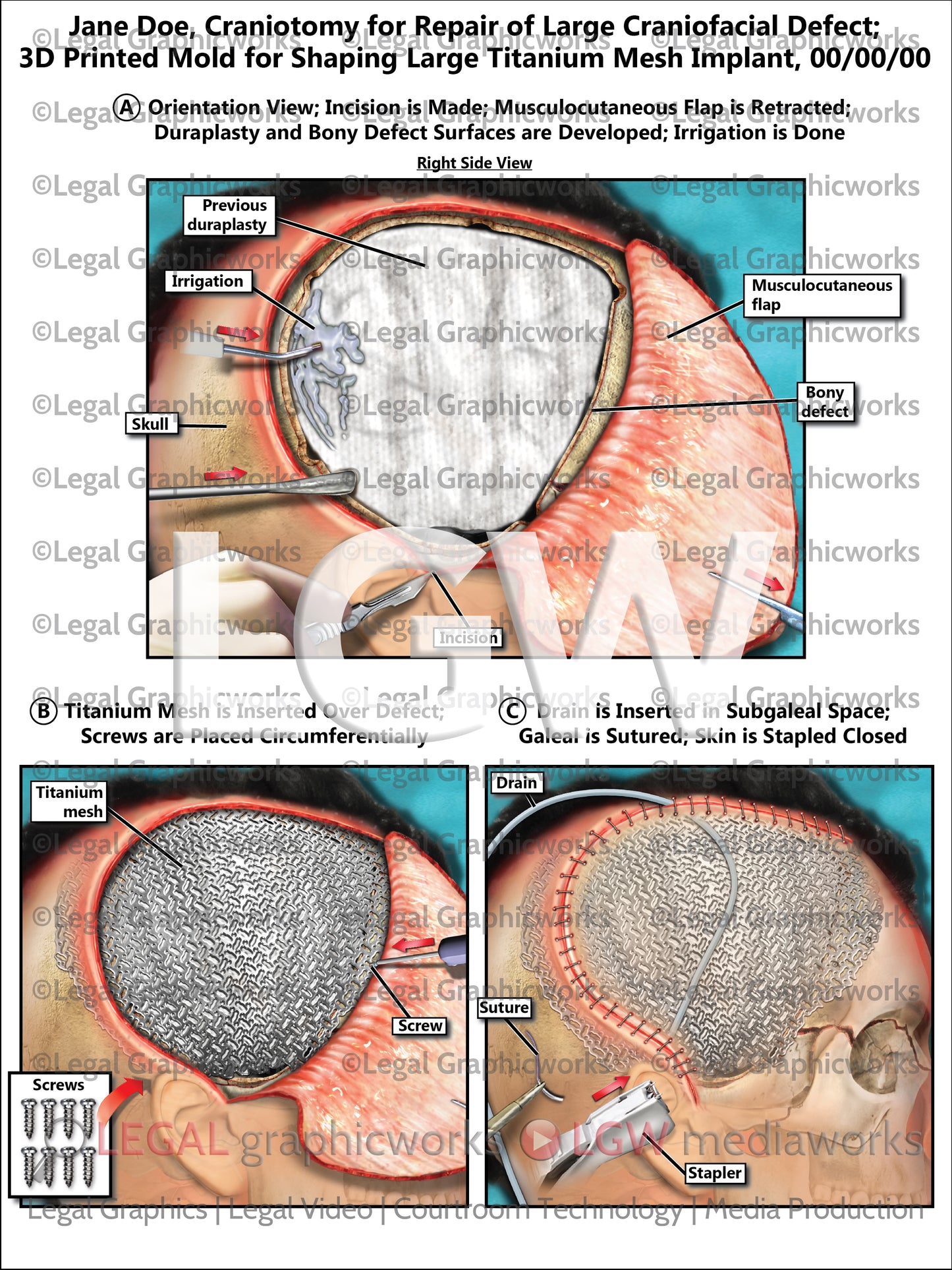 Craniotomy for Repair of Large Craniofacial Defect; 3D Printed Mold for Shaping Large Titanium Mesh Implant