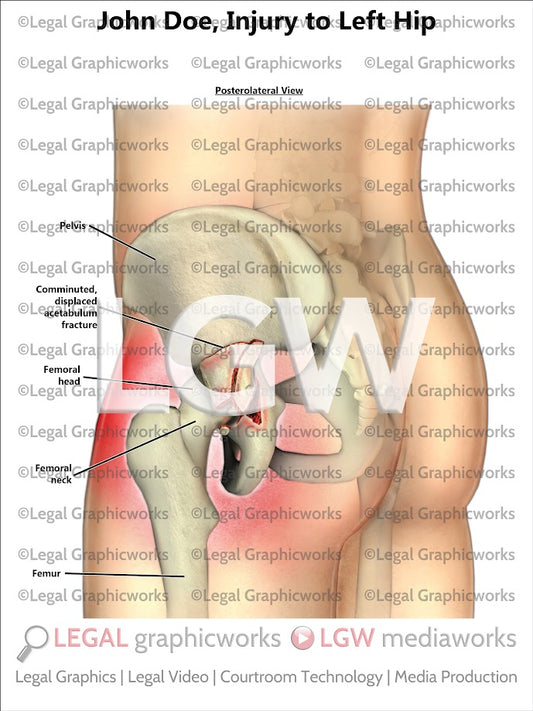 Injury to Left Hip