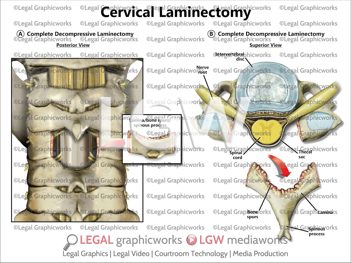Cervical Laminectomy