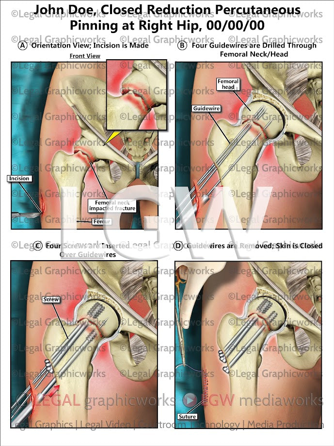 Closed Reduction Percutaneous Pinning at Right Hip