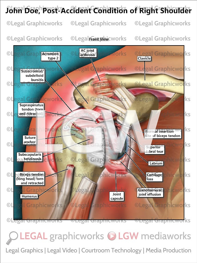 Post-Accident Condition of Right Shoulder