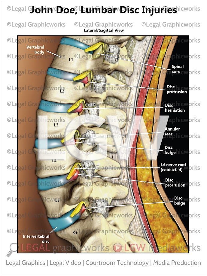 Lumbar Disc Injuries