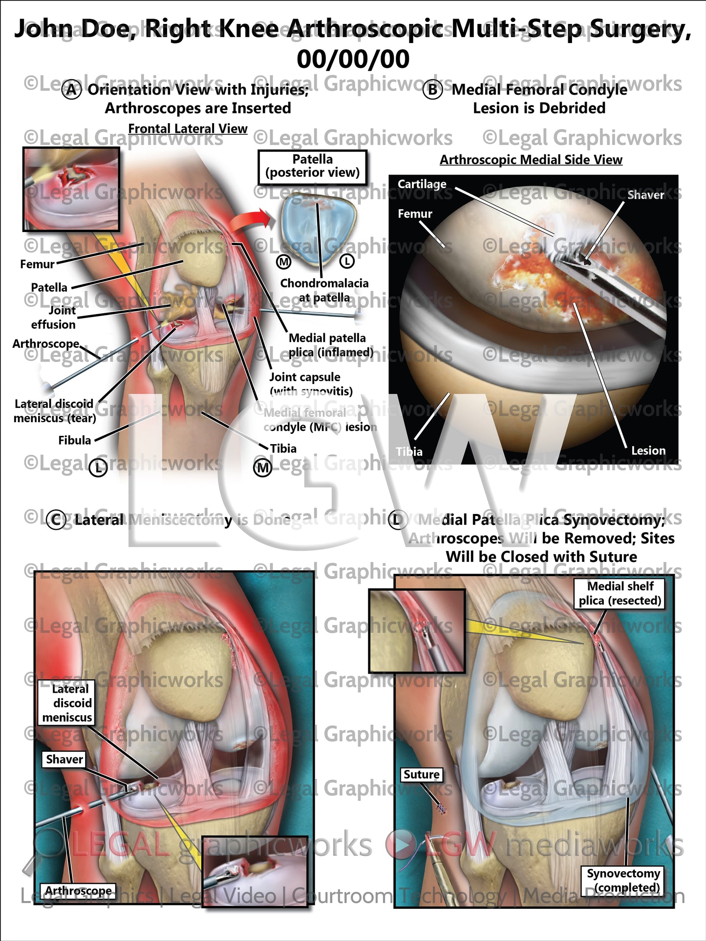 Right Knee Arthroscopic Multi-Step Surgery
