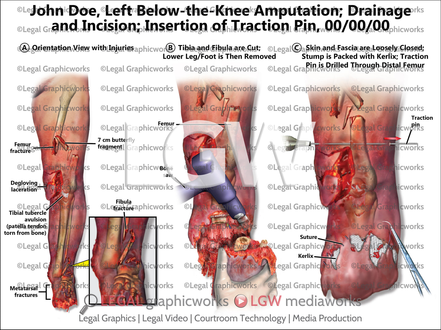 Left Below-the-Knee Amputation; Drainage and Incision; Insertion of Traction Pin