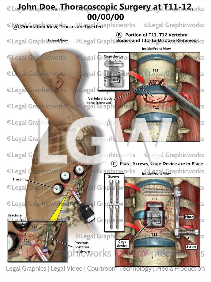 Thoracoscopic Surgery at T11-12