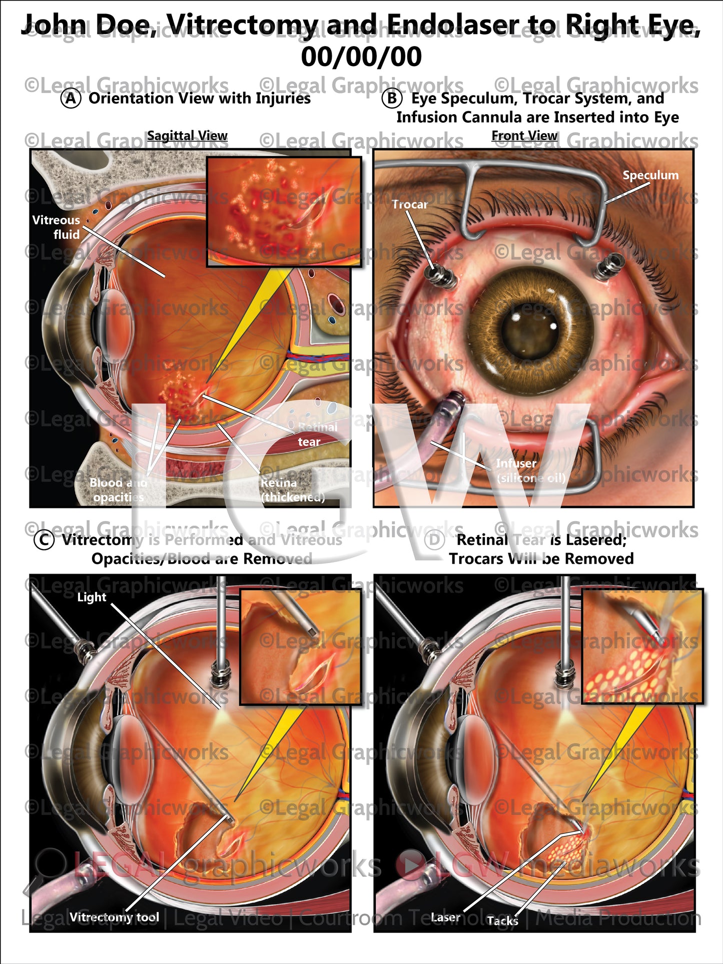 Vitrectomy and Endolaser to Right Eye