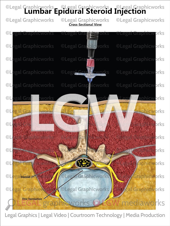 Lumbar Epidural Steroid Injection